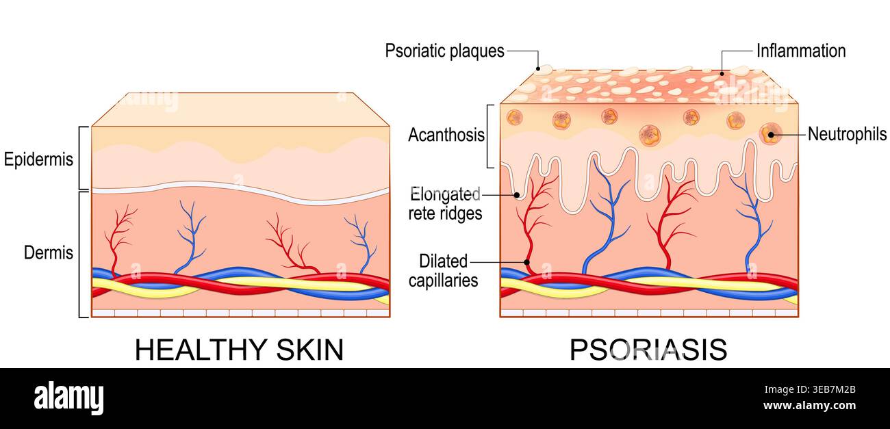 Irregular Skin Psoriasis. Autoimmune skin condition. Cross section of normal skin, and ...