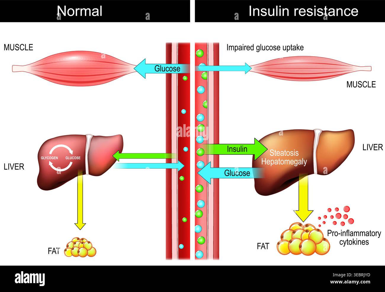 Insulin resistance. Balance between Insulin and Glucose. Role of Liver ...