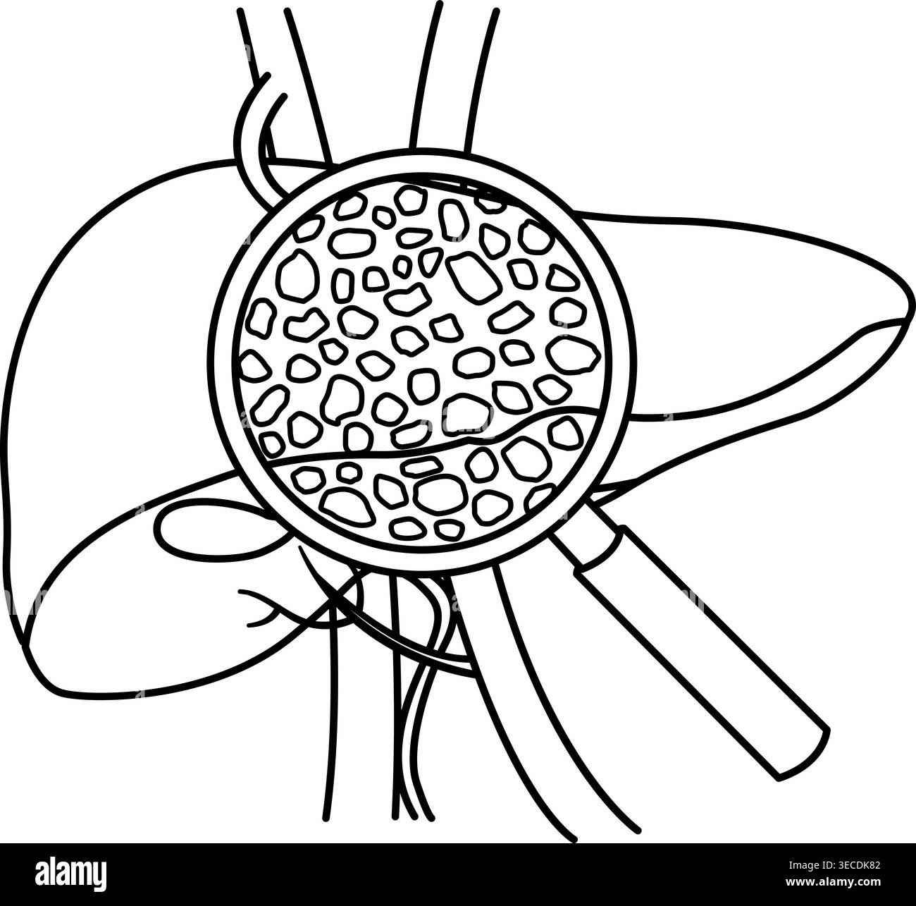 Liver cirrhosis disease vector Black and White Stock Photos & Images ...