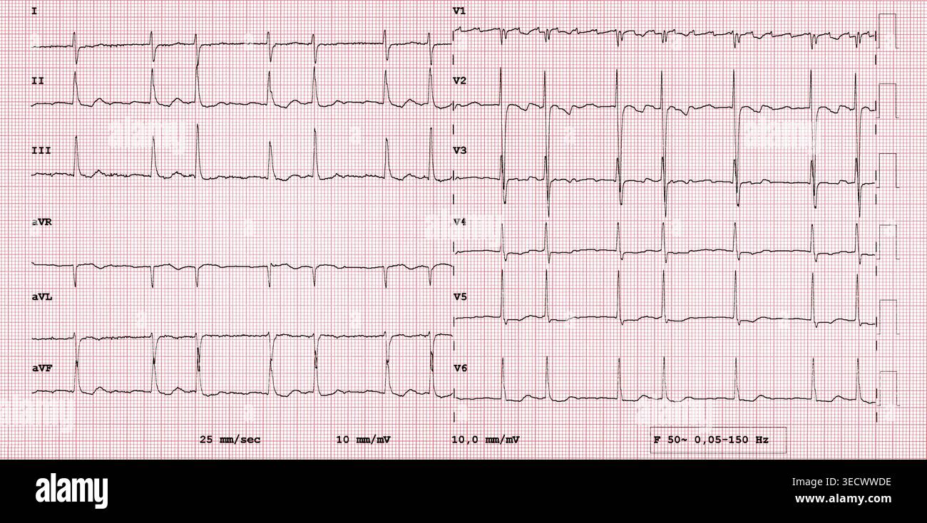 Atrial fibrillation ecg hi-res stock photography and images - Alamy