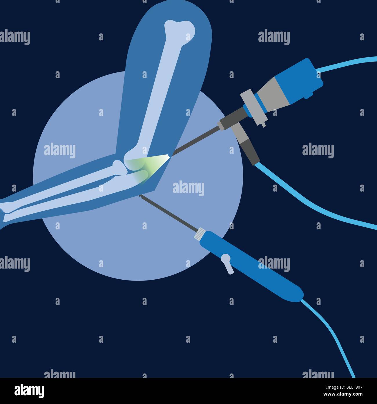 Flat vector illustration of elbow arthroscopy surgery featuring ...
