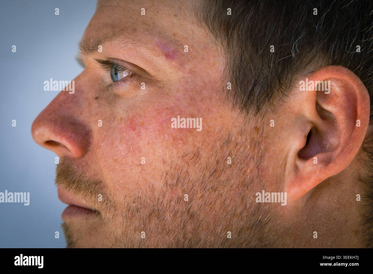 Brow skin cancer hi-res stock photography and images - Alamy