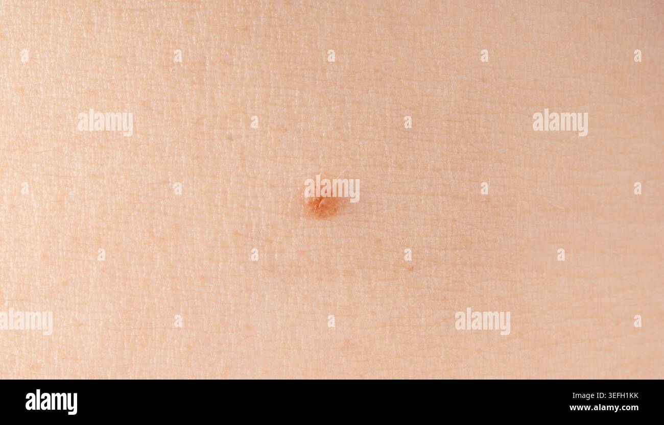 Skin mole spot closeup. Human birthmark, benign nevus or mole macro ...