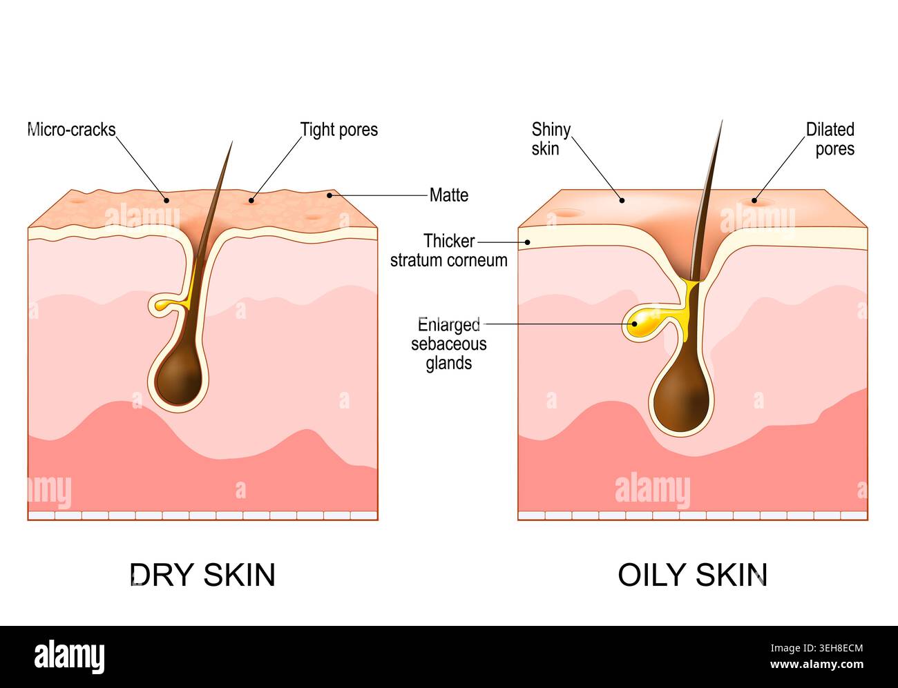 Cross section of skin inflammation hi-res stock photography and images ...