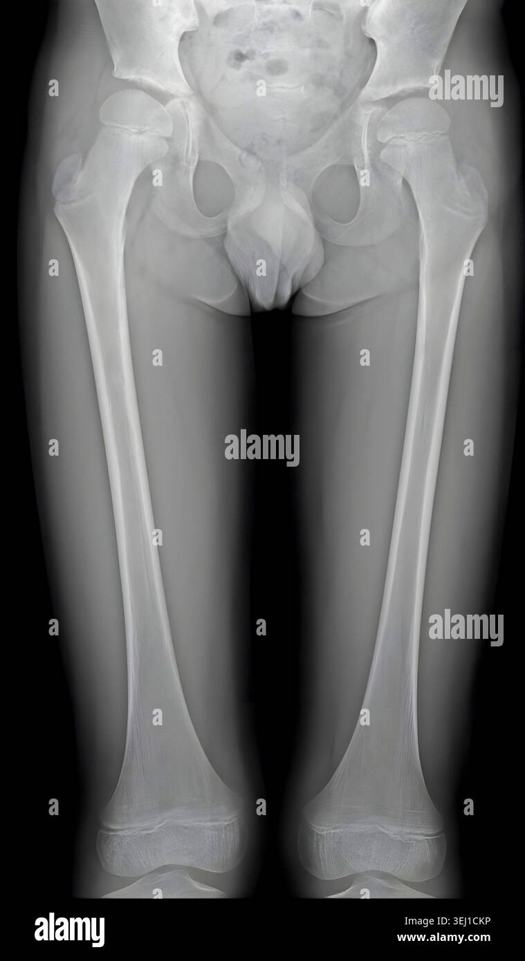 Skeleton rickets hi-res stock photography and images - Alamy