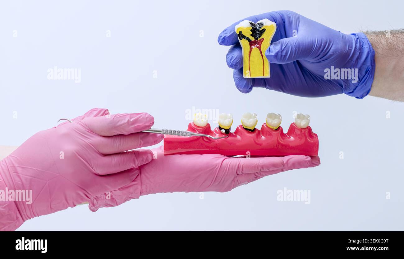 Toothache Model Severe toothache and endodontics concept. Hands comparing a jaw model ...
