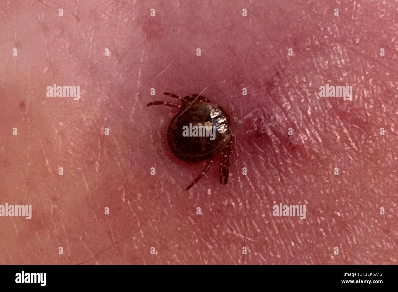 Close view of a Lone Star tick (Amblyomma americanum) embedded in human skin, showing the characteristic white dorsal spot and localized irritation at the bite site. Photographed in Olathe, Kansas, on June 28, 2025. Stock Photo