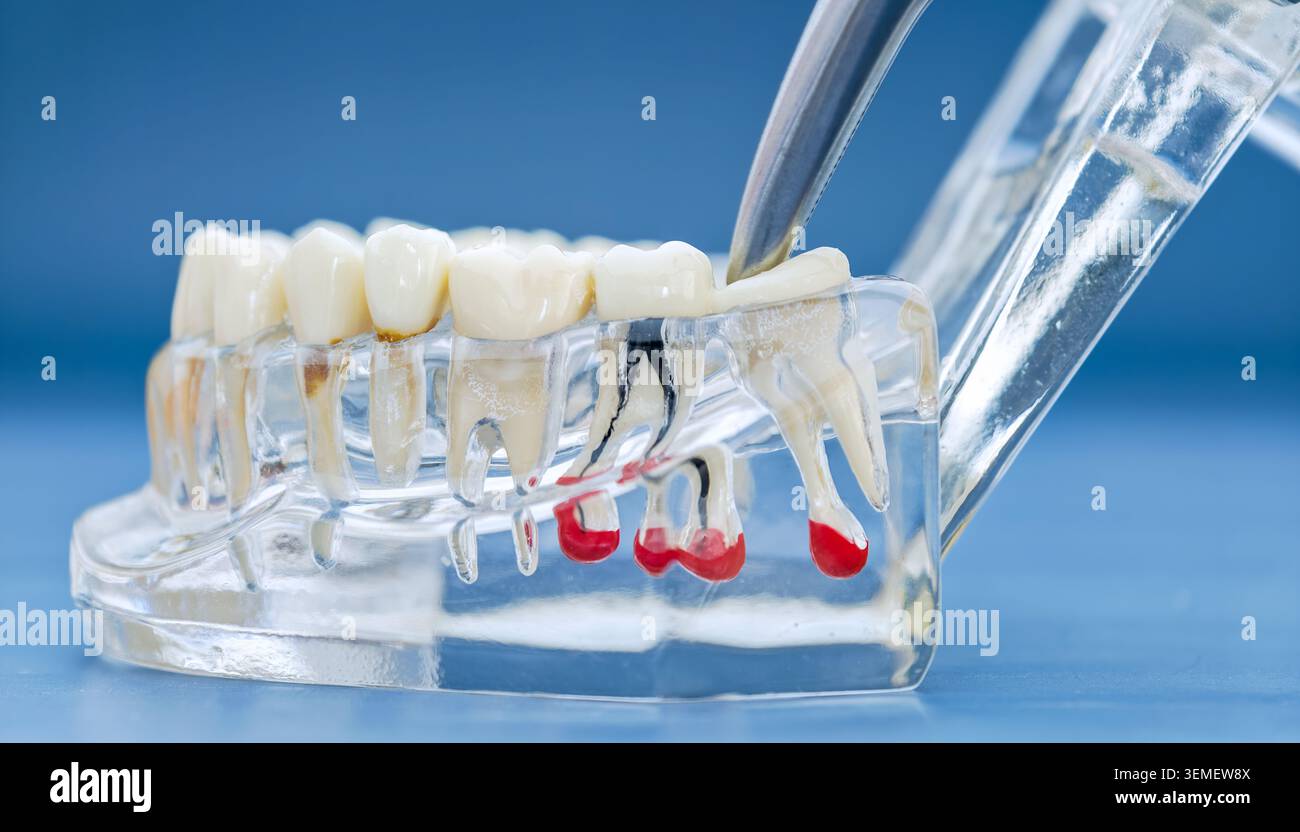 Apical tooth hi-res stock photography and images - Alamy