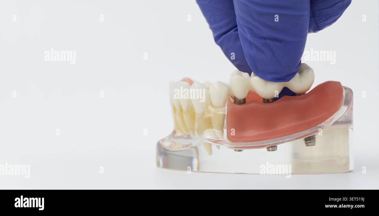 Implant Supported Prosthetic Bridge Installation on Jaw Model Stock Photo