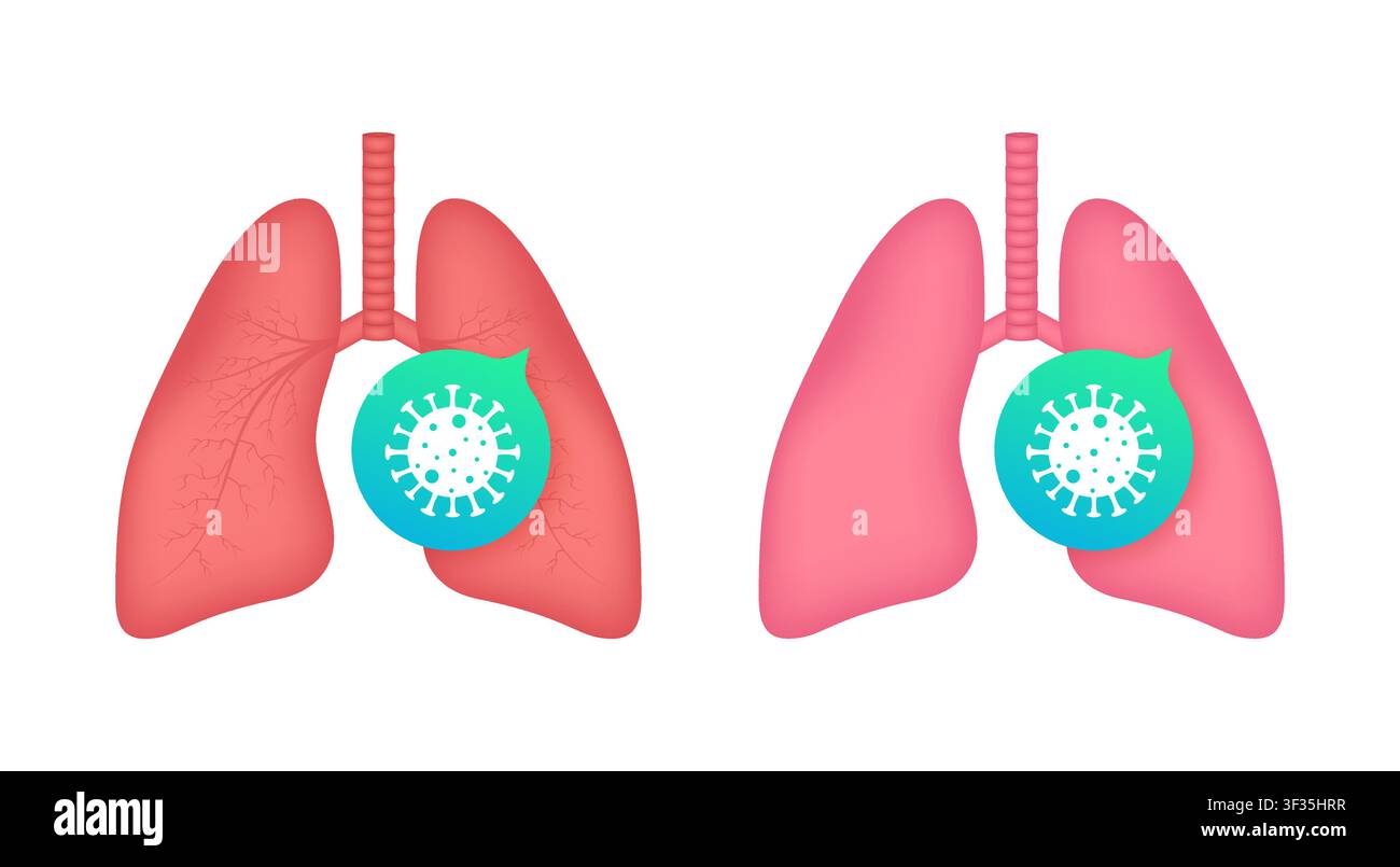 Human lungs affected and protected from coronavirus infection Stock Vector