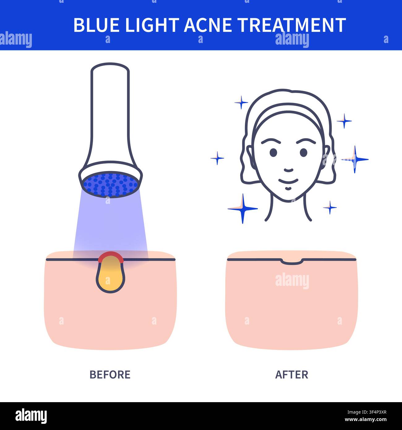 Blue Acne Face Chart Vector Illustration Stock Vector