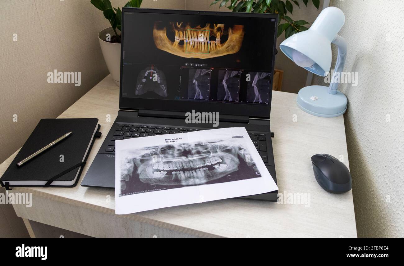 Laptop Displaying Dental 3D CBCT Tomography Software with Printed Jaw Panoramic X-Ray on Keyboard Stock Photo