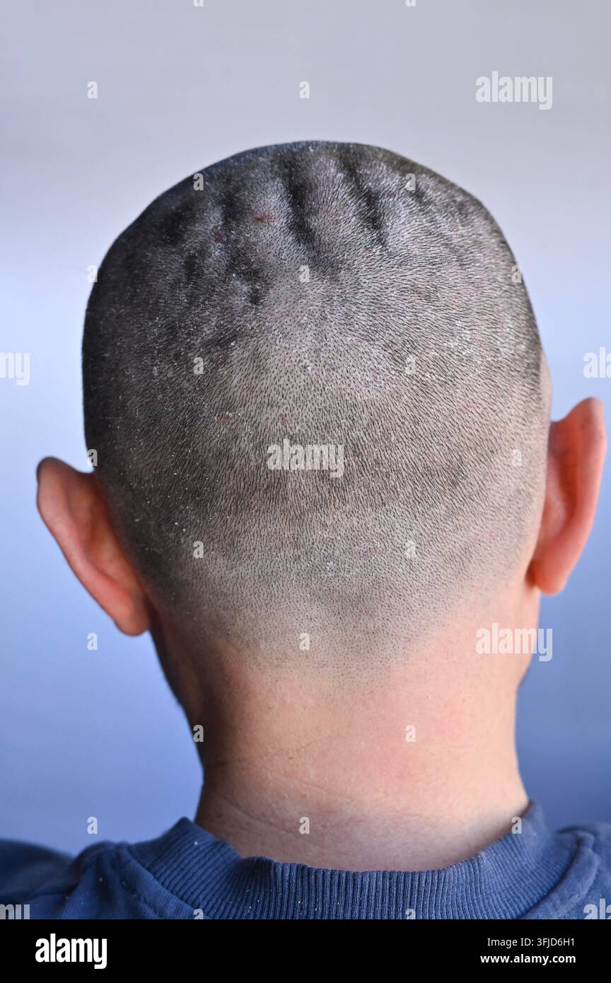 Human head seborrheic dermatitis hi-res stock photography and images ...
