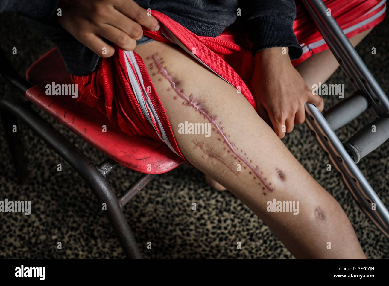 Palestinian Plate Palestinian Boy Who Lost Family in Israeli Strike Awaits Treatment ...