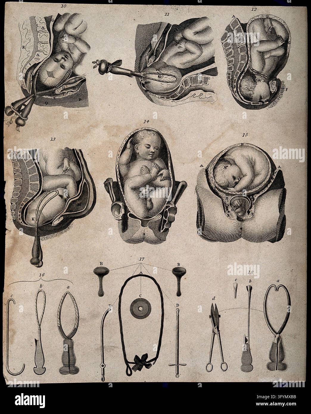 Instrument Land Six diagrams of babies being delivered with the aid of forceps and ...