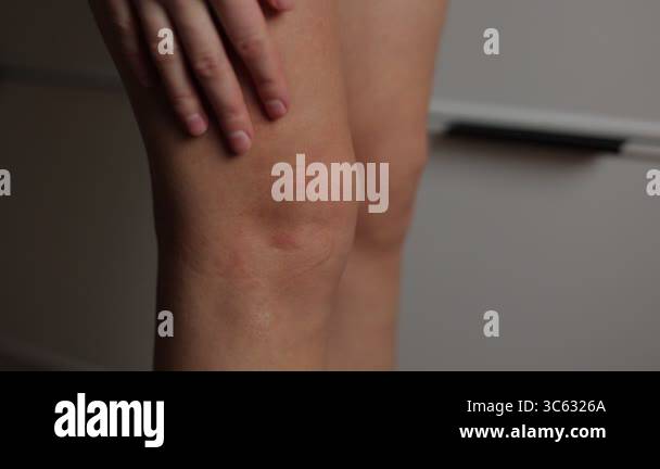 Insect Bite Rash Leg Allergic rash on leg itches. Woman strongly scratches her skin on knee ...