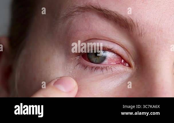 Close up of caucasian female face with one red irritated eye suffering ...