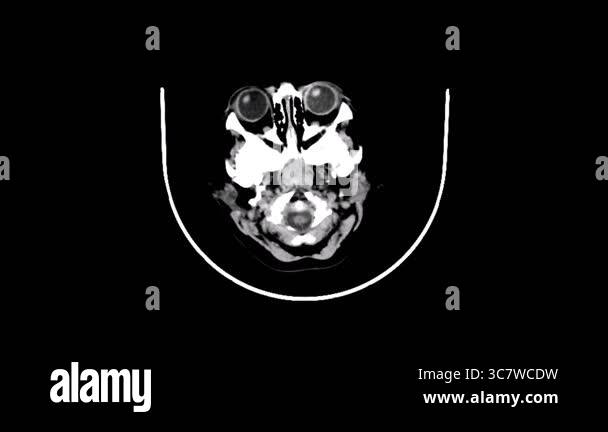 Computed tomography ct scan head Stock Videos & Footage - HD and 4K ...