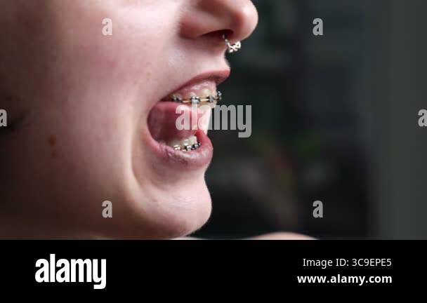 Girl with braces removing food with fingers and tongue, close-up of ...
