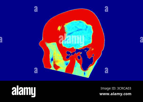 MRI Scan of the Human Brain with Color Mapping: Detailed Visualization ...