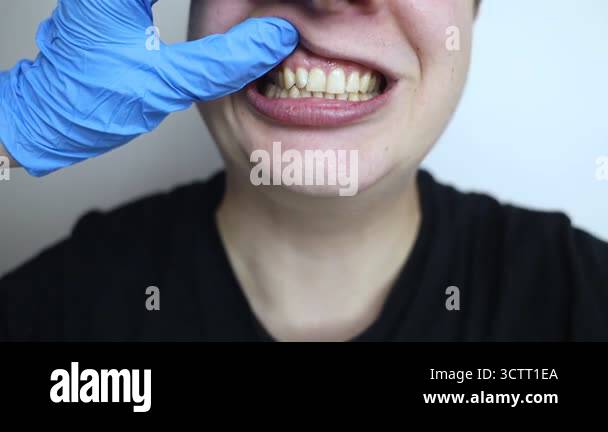 Tooth Root Injection Dental injection for gum recession treatment. Exposure of tooth root ...