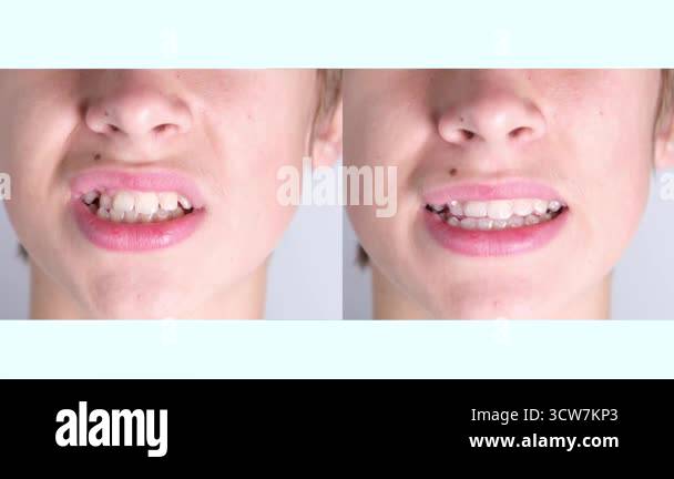 A Teenage Patients Teeth Are Shown With And Without Clear Photo Inspiration