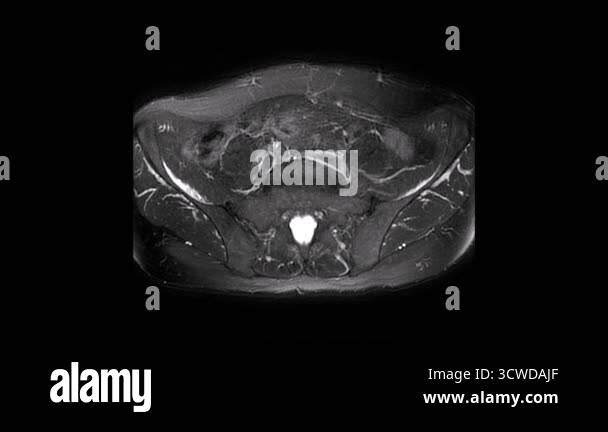 Lumbar disc axial Stock Videos & Footage - HD and 4K Video Clips - Alamy