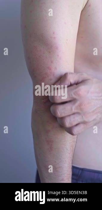 Man with skin irritation and inflammation after chemical exposure ...