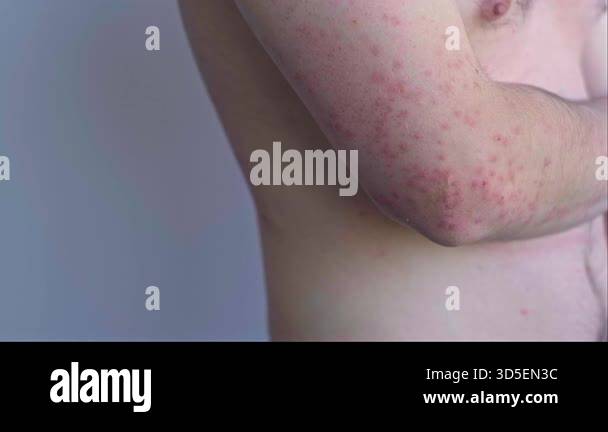 Man bright red pinpoint rash Stock Videos & Footage - HD and 4K Video ...