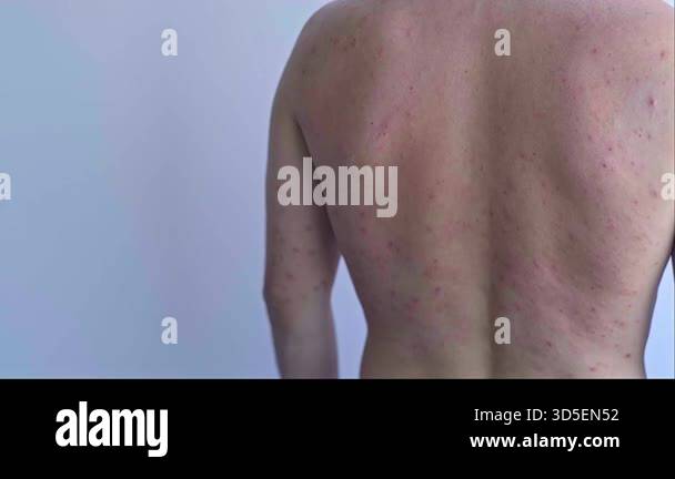 Small red rash spreads across a mans face and body showing gradual ...