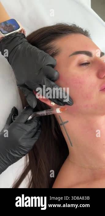 Aesthetic Medicine Close up Of Collagen Biorevitalization Treatment aesthetic-medicine-close-up-of-collagen-biorevitalization-treatment