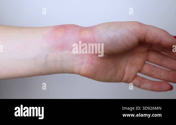 Close-up of a swollen wrist with visible redness, inflammation, and ...