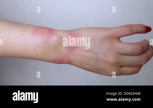 Close-up of a swollen wrist with visible redness, inflammation, and ...