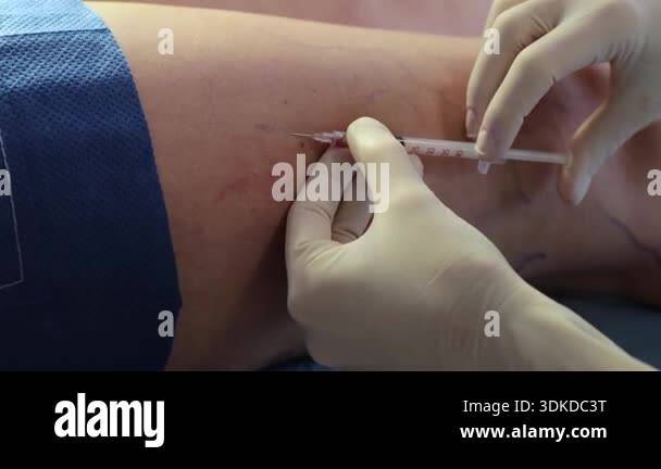 Leg sclerotherapy precise vein injection Stock Videos & Footage - HD ...