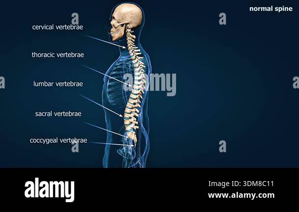 Backbone Slanting 3d animation of sway back spine condition showing exaggerated curve ...
