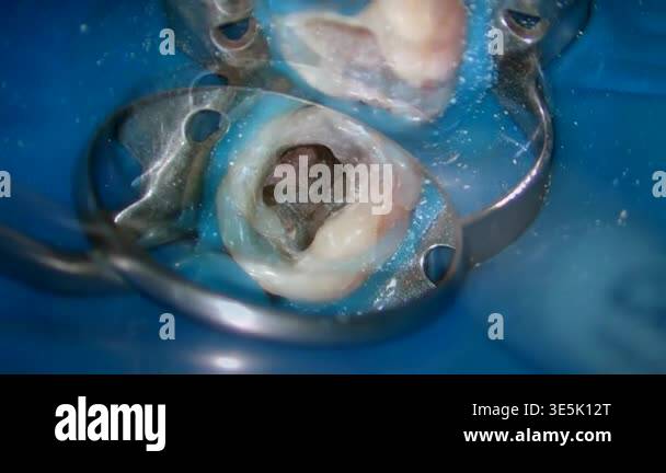 Tooth Root Injection injecting process of calcium inside tooth root Stock Video Footage - Alamy