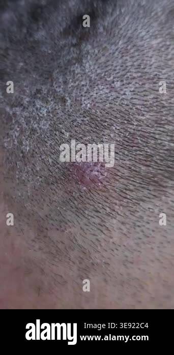 Scalp with visible flakes and irritation from seborrheic dermatitis ...
