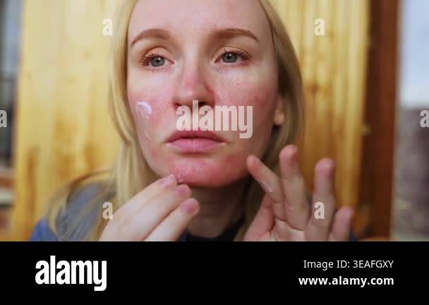 Rosacea and couperosis of the skin. The girl suffers from redness on ...
