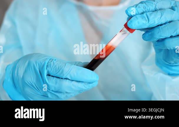Close up of laboratory worker in protective gloves examining blood ...