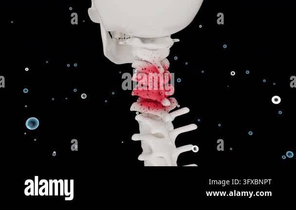 Medical 3D Animation for Cervical Spine Injury Repair+ alpha channel ...
