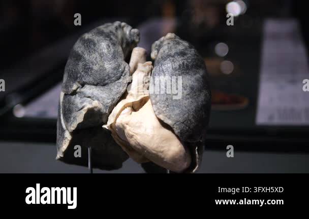 Anatomical lung and heart model displays dark, mottled lungs around ...