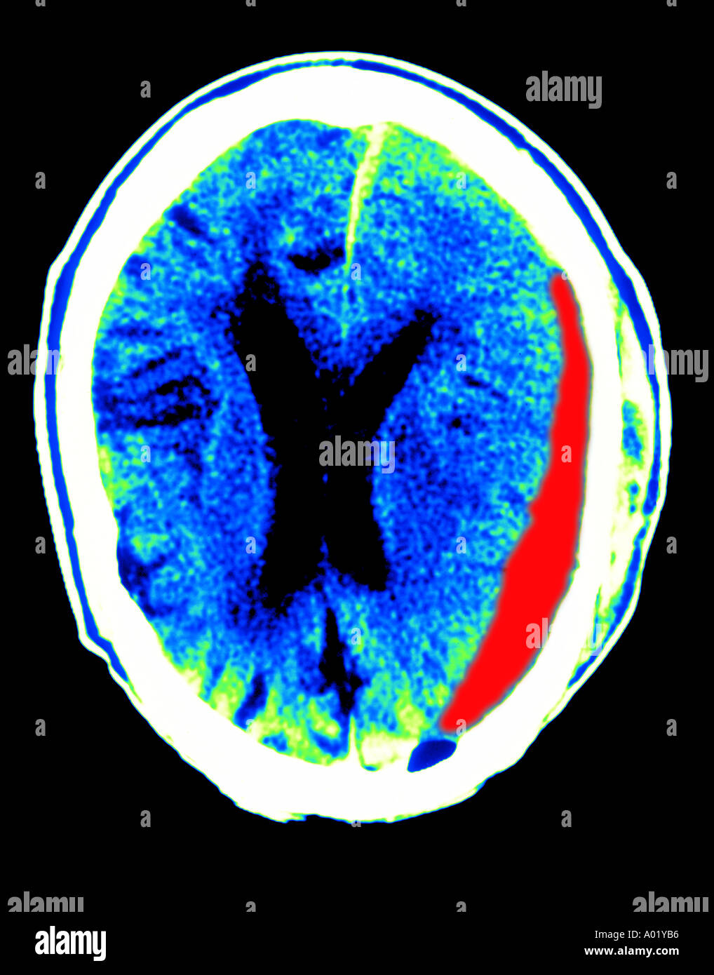 CT scan brain subdural hematoma from trauma Ventricles compressed and shifted laterally Stock Photo