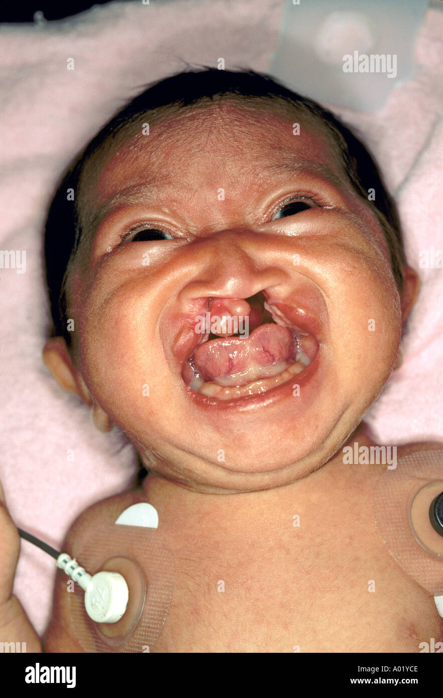 cleft palate and lip plastic surgery 6 week old child Guatemala surgical clinic  Stock Photo