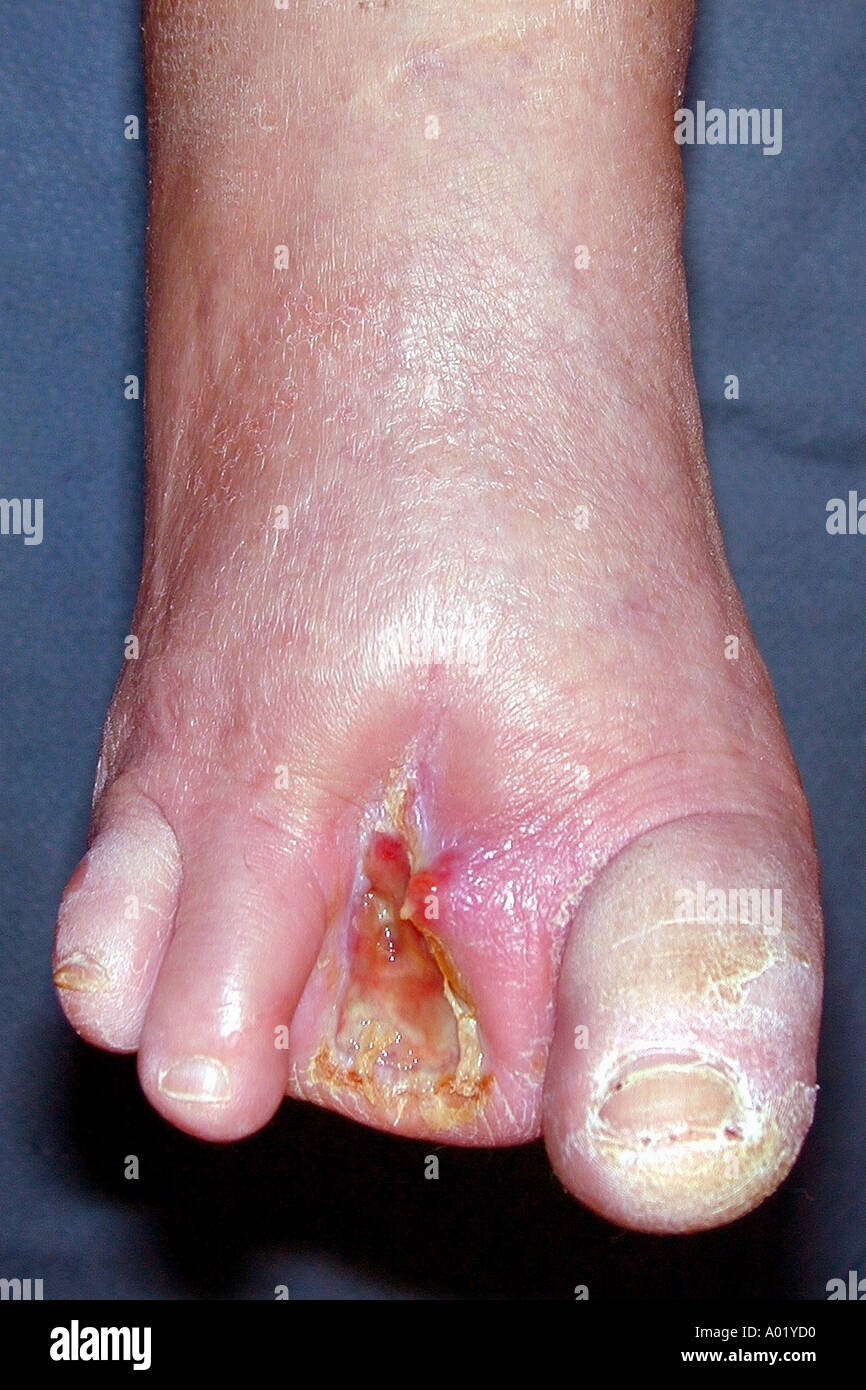 Diabetic foot after amputation of two toes Poor wound healing necrotic tissue at site of amputation cellulitis  Stock Photo