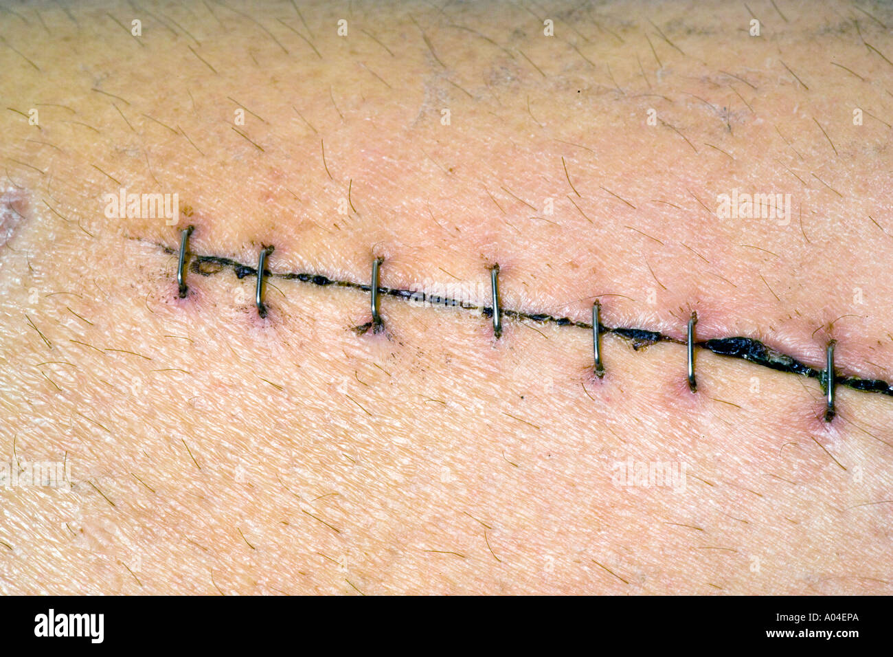 Surgical Staples Hi Res Stock Photography And Images Alamy