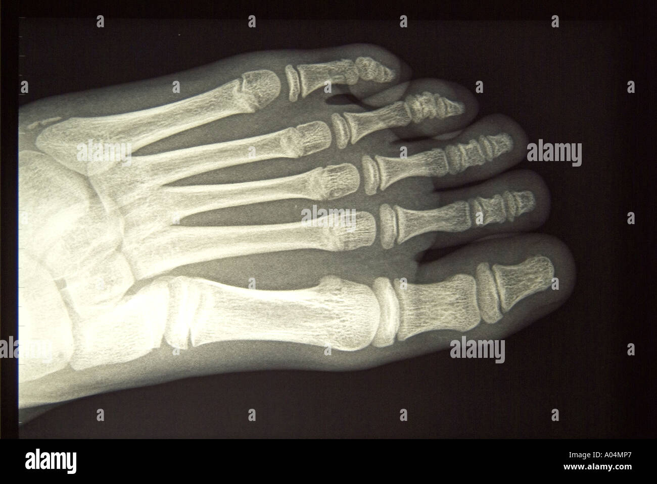 Film x- ray of the left foot of a healthy 9 year old girl' Stock Photo
