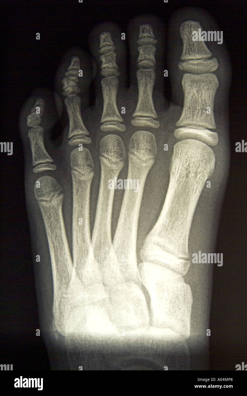 Film x- ray of the left foot of a healthy 9 year old girl Stock Photo