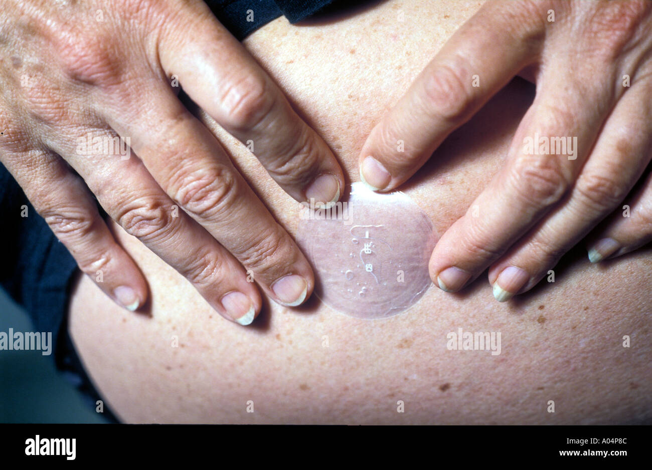 Menopausal woman putting on a HRT patch. Stock Photo