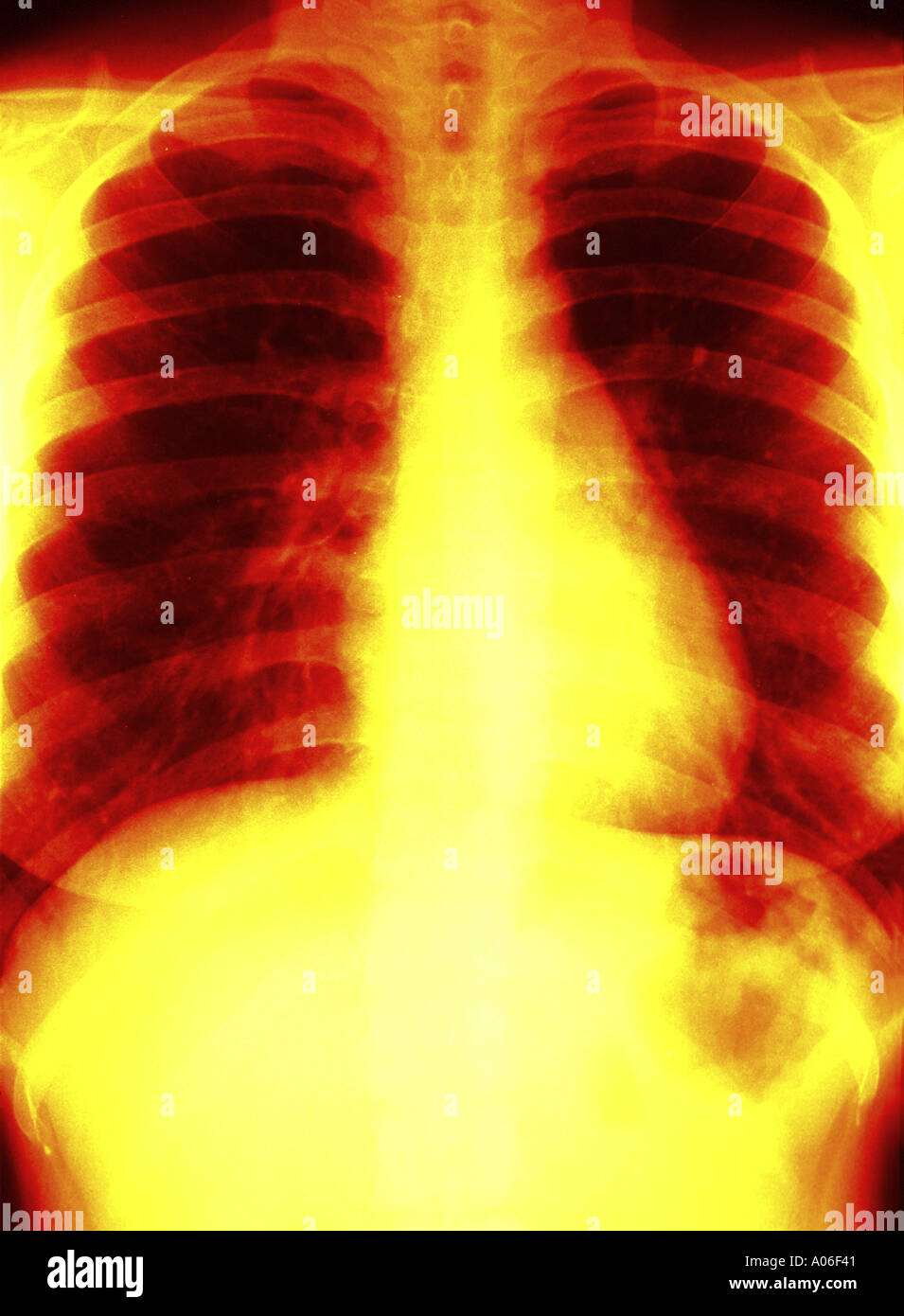 Chest X Ray Stock Photo Alamy