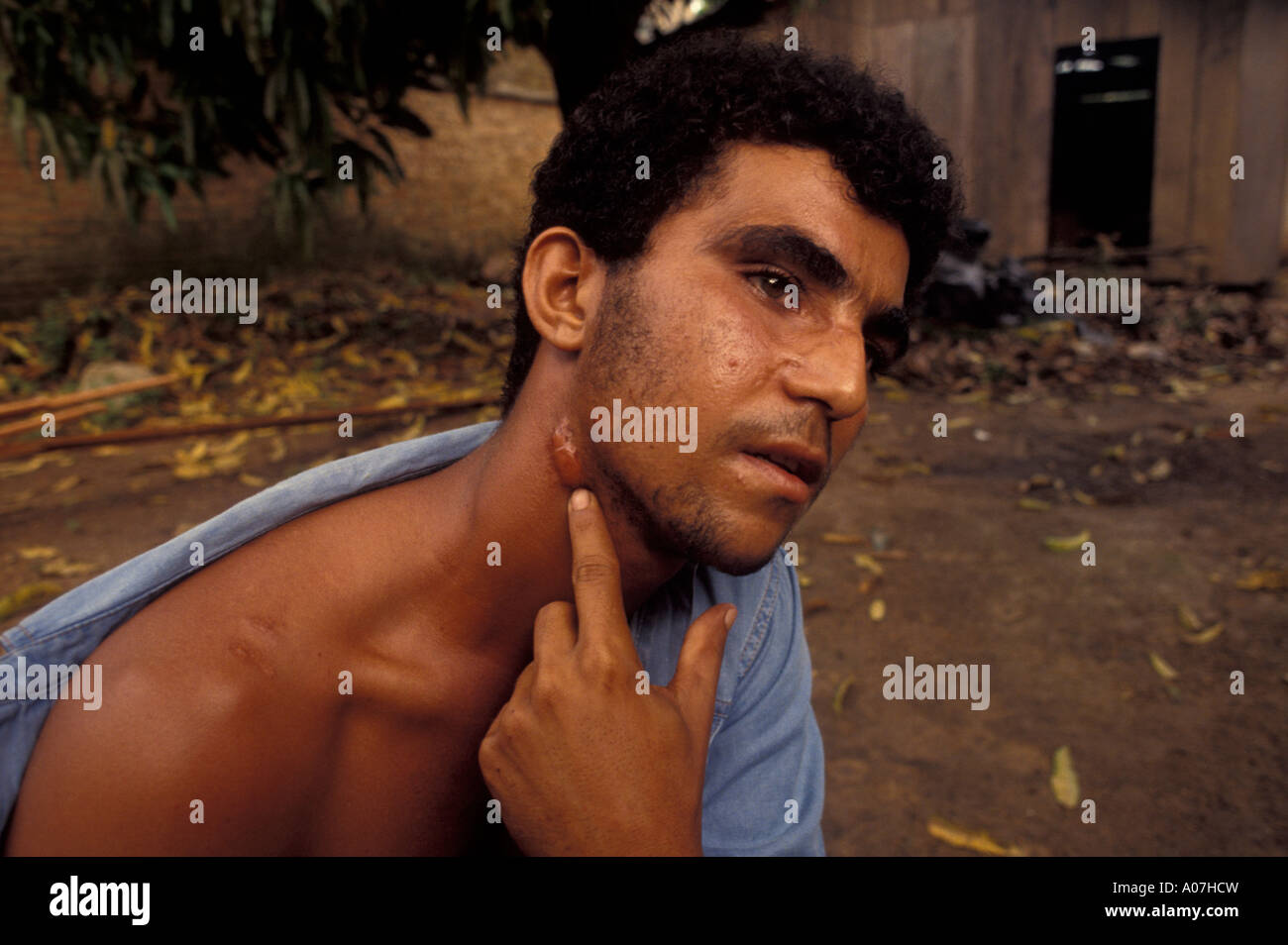 Contemporary slavery in Amazon rainforest, Brazil. Victim of torture